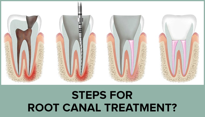 Root Canal Steps